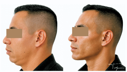 Avant/après masculinisation faciale d’un homme – définition de la mâchoire et projection du menton après injections d’acide hyaluronique.