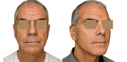 Avant/après masculinisation du visage chez un homme mature après injections d’acide hyaluronique pour restaurer les volumes et renforcer les traits.