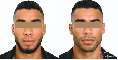 Avant/après masculinisation faciale chez un homme jeune – mâchoire plus carrée, jawline définie et traits renforcés après injections.