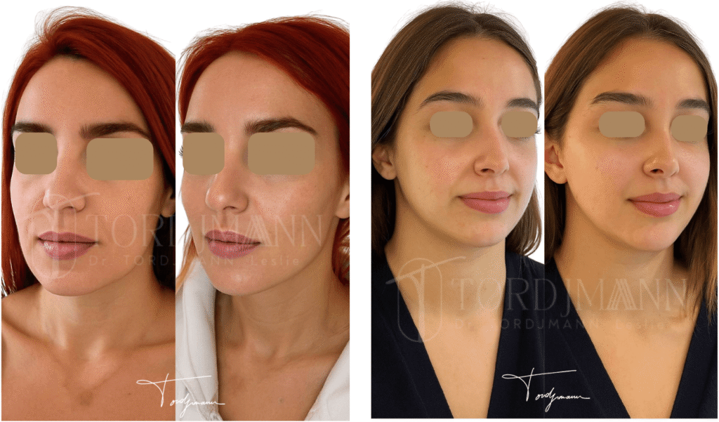 Résultat avant/après injection acide hyaluronique au menton