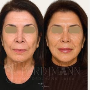 Résultat harmonisation faciale sur traits relâchés avec restauration des volumes – Ablon-sur-Seine