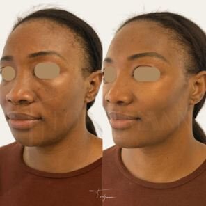 Avant-après d’un traitement d’harmonisation du visage avec ovale affiné – Dr Tordjmann Leslie – Paris