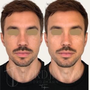 Résultat avant-après de redéfinition mandibulaire chez l’homme – Paris – Dr Tordjmann Leslie