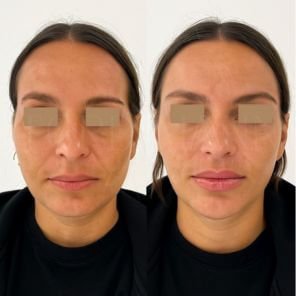 Résultat harmonisation faciale sur traits relâchés avec restauration des volumes – Ablon-sur-Seine